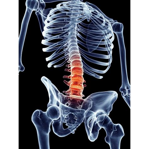 Treatment of Lumbar and Thoracic Spine Fracture - Singapore Sports and ...