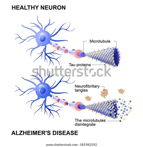 65 Neurofibrillary Tangles Images, Stock Photos & Vectors | Shutterstock