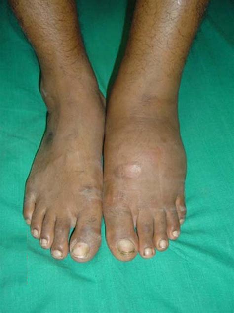 Charcot arthropathy