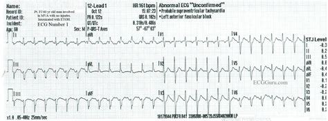 Sinus Tach vs SVT In An Inebriated Patient | ECG Guru - Instructor ...