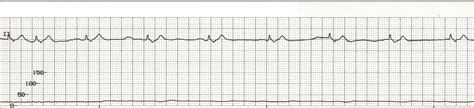 Float Nurse: Various rhythms with arterial blood pressure waveform