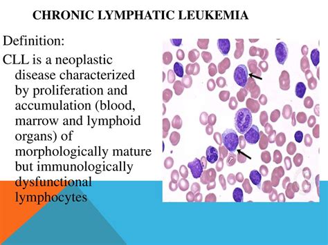 Chronic lymphocytic leukemia - online presentation