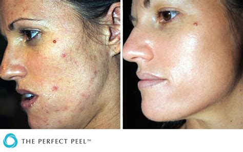 The Perfect Peel® | Renew Medical Aesthetics - Cheshire Clinic