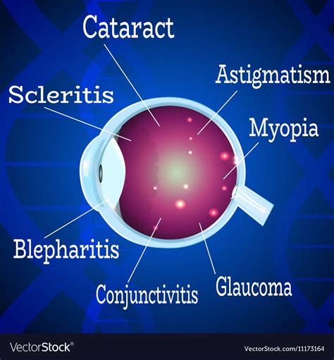 Human eye diseases 2 Royalty Free Vector Image