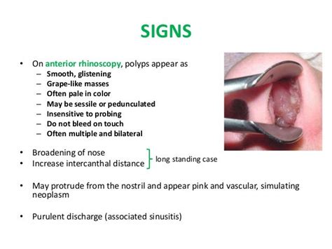 NASAL POLYPS