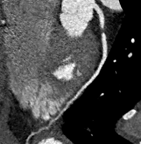 020419-Fig-2-SHEN-CT-CORONARY-ANGIOGRAM - Medical Forum