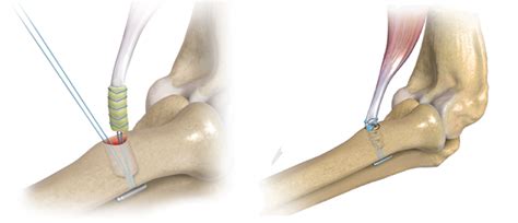 Biceps Tendon Tear - Raleigh Hand Surgery — Joseph J. Schreiber, MD