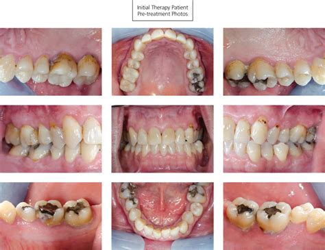 8: Case studies in ultrasonic debridement | Pocket Dentistry