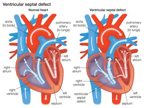 Ventricular septal defect causes, types, symptoms, diagnosis, treatment ...