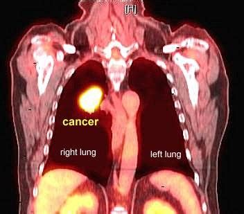 PET Scans in Cancer Cases