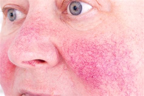 A novel target for rosacea treatment