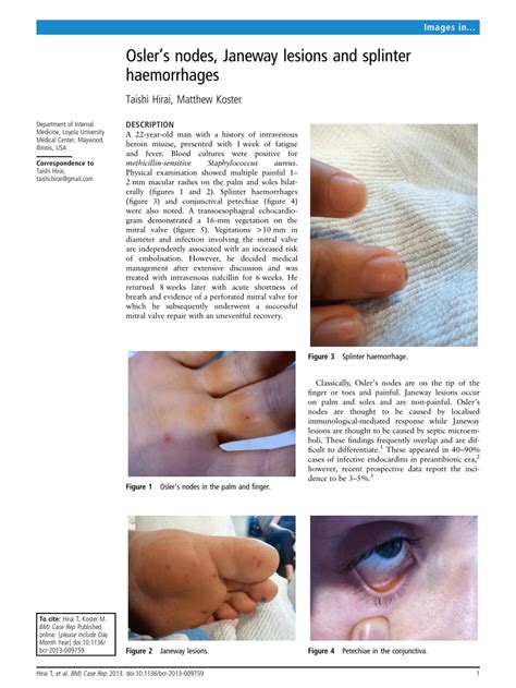 Image Infective Endocarditis Janeway Lesions Merck