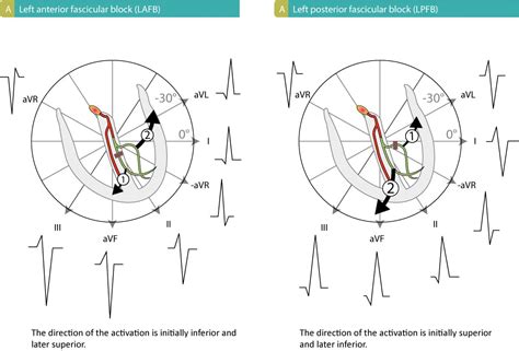 Fascicular block (hemiblock): left anterior & left posterior fascicular ...