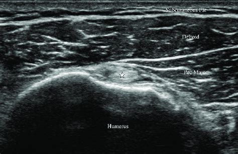 Ultrasound view of the long head of the biceps tendon in short axis ...