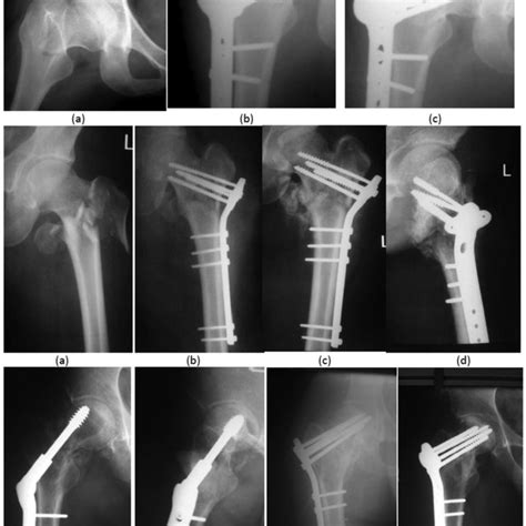 Acute Femoral Fracture