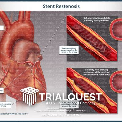 Stent Restenosis - TrialExhibits Inc.