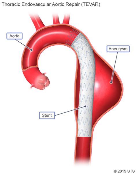 Thoracic Aortic Aneurysm - Newport Cardiac & Thoracic Surgery