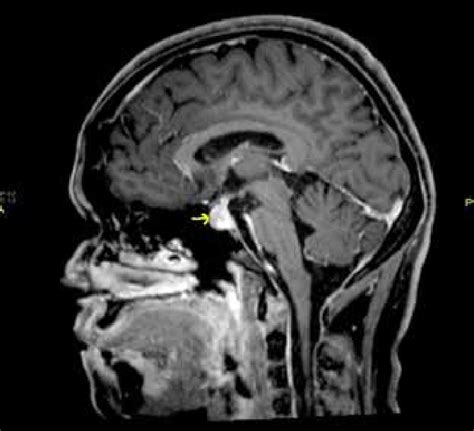 Pituitary Gland Tumor Mri