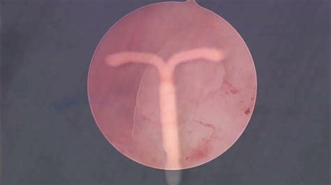 Hysteroscopic Polypectomy and Removal of Embedded Intrauterine Device ...