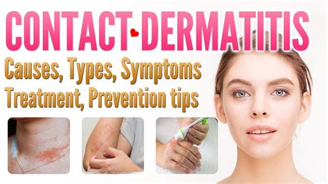 Contact Dermatitis: Symptoms, Causes Treatment, 60% OFF