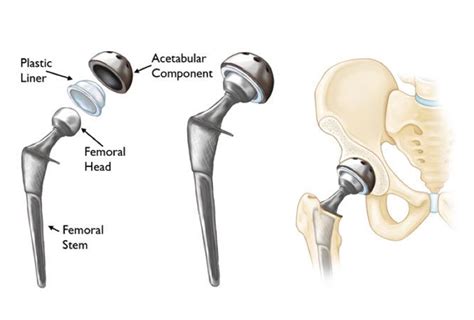 Partial Hip Replacement Surgery by Dr David Slattery