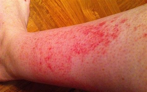 Rash on Leg Causes, Itchy, Relief Treatment Remedies - Skincarederm