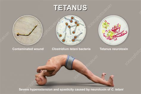 Clostridium Tetani Symptoms