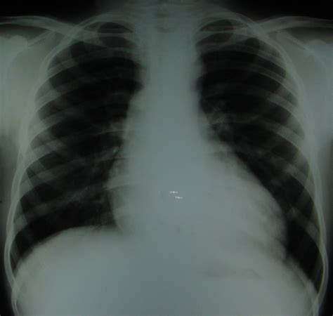 Dilatation of ascending aorta – All About Cardiovascular System and ...