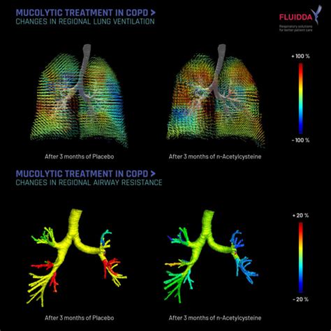 Understanding Mucus in Chronic Obstructive Pulmonary Disease (COPD ...