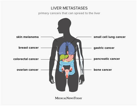 Liver Cancer Stages