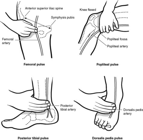 How To Assess Pedal Pulses