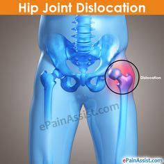 7 Best Hip dislocation ideas | hip dislocation, dislocation, hip brace