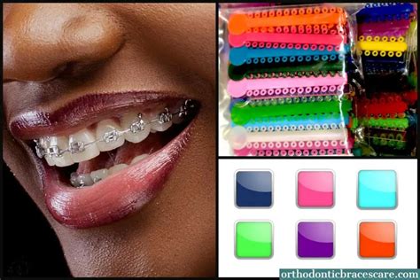 Best Braces Colors For Dark Skin - How To Choose | Orthodontic Braces Care