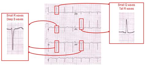 Left anterior fascicular block - Deranged Physiology