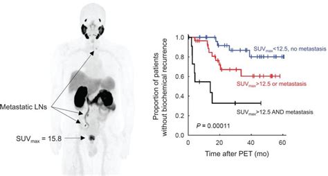 Prostate cancer: PSMA PET/MRI accurately predicts recurrence risk ...