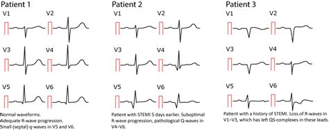 ECG interpretation: Characteristics of the normal ECG (P-wave, QRS ...