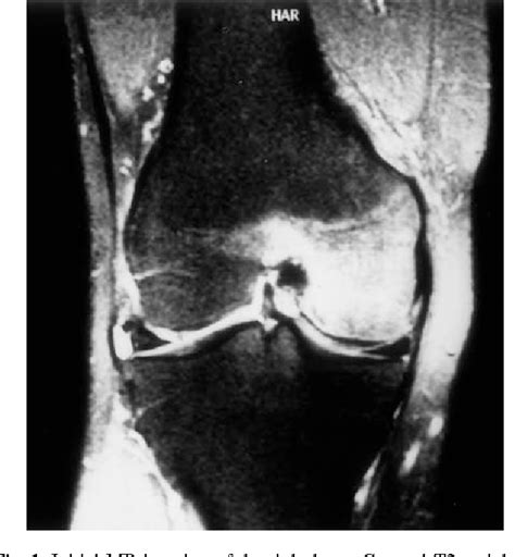 Migrating transient bone marrow edema syndrome of the knee: MRI ...