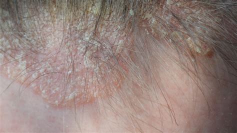 Scalp Eczema Psoriasis: Differences, Pictures And Treatment, 42% OFF