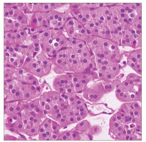 Renal Oncocytoma | Basicmedical Key