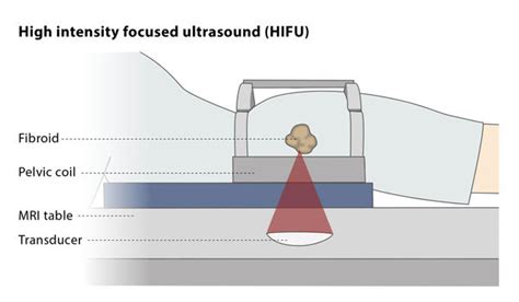 High-intensity focused ultrasound (HIFU) – CIRSE