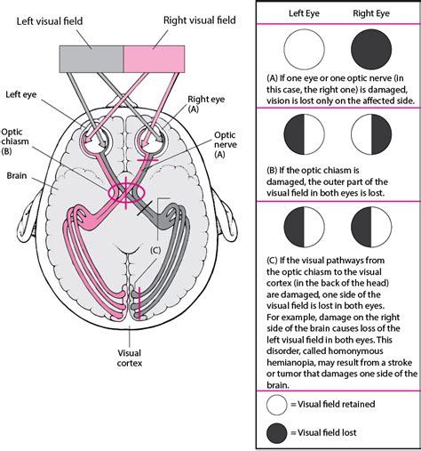 Overview of Optic Nerve Disorders - Eye Disorders - MSD Manual Consumer ...