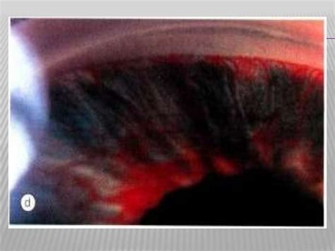 Neovascular glaucoma