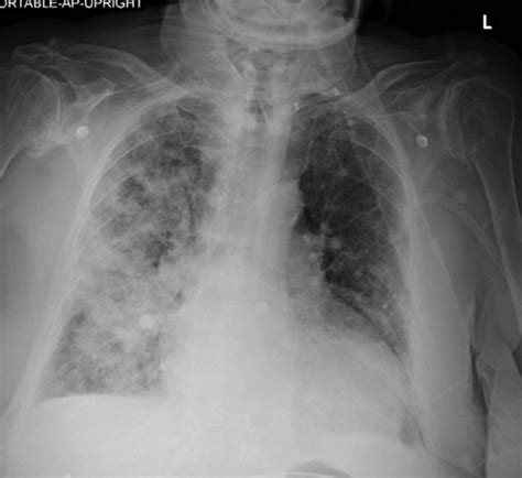 Cureus | Unilateral Diffuse Alveolar Hemorrhage Due to Selective ...