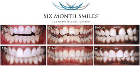 Invisalign & Six Month Smiles in Newton & Boston MA | Newton Dental ...