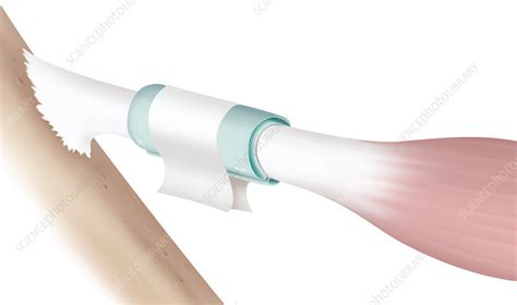 Tendon, illustration - Stock Image - C035/4649 - Science Photo Library