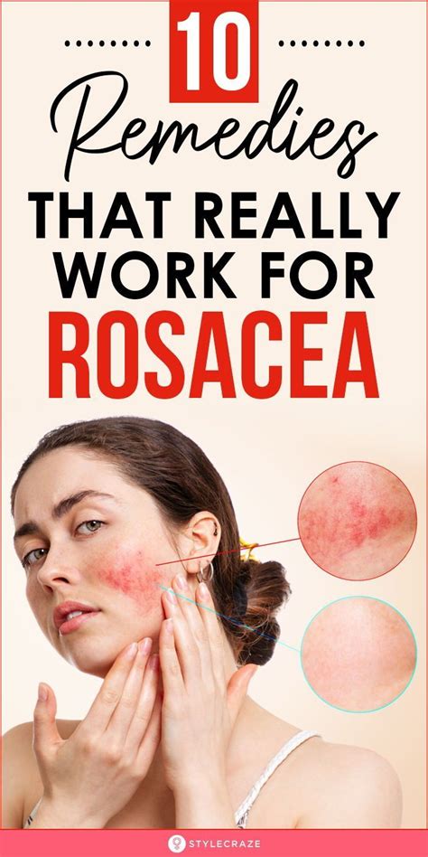 Rosacea remedies – Artofit