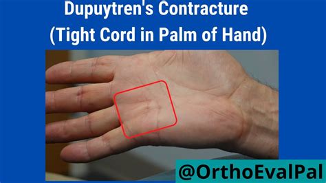 Dupuytren's Contracture (Tight Cord in Palm of Hand) - YouTube