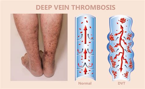 Deep Vein Thrombosis What Is It Causes Prevention And More Osmosis ...