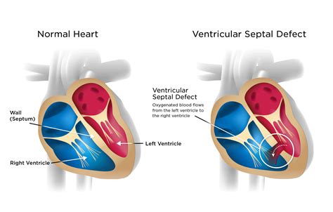 Types Of Atrial Septal Defect Its Causes Symptoms