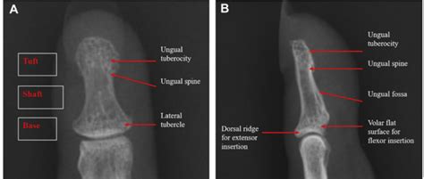 Review of Distal Phalanx Fractures - Sports Medicine Review